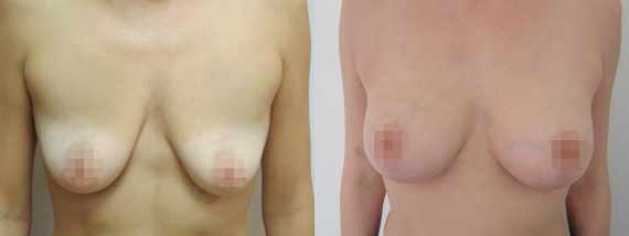 modelace prsou s augmentací před a po