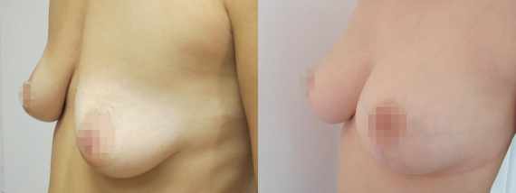 modelace prsou s augmentací před a po