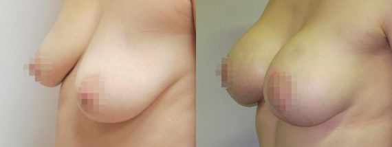 modelace prsou s augmentací před a po