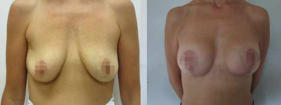 Augmentace s modelací prsou