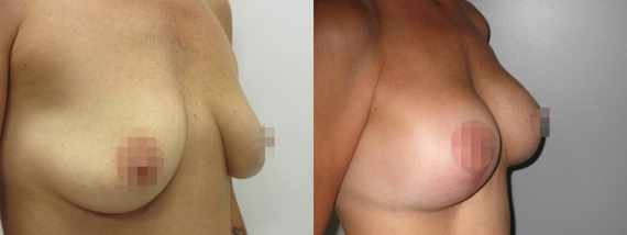 Augmentace s modelací prsou