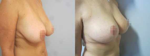 Fotogalerie - modelace prsou před a po