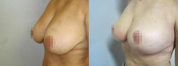 Fotogalerie - modelace prsou před a po