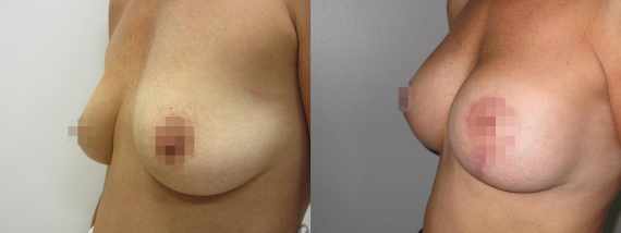 Augmentace s modelací prsou