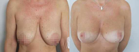 Fotogalerie - modelace prsou před a po