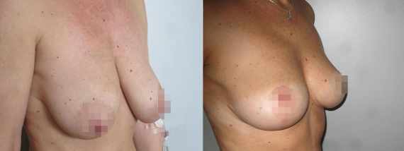 Fotogalerie - modelace prsou před a po