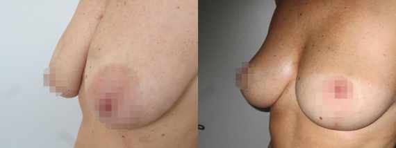 Fotogalerie - modelace prsou před a po