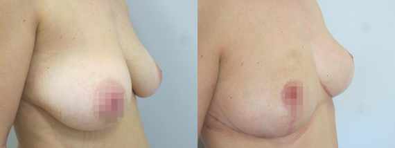 Fotogalerie - modelace prsou před a po