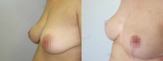 Fotogalerie - modelace prsou před a po