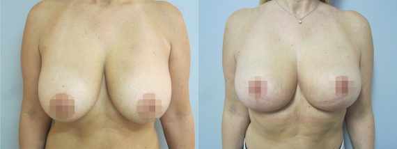 Fotogalerie - modelace prsou před a po