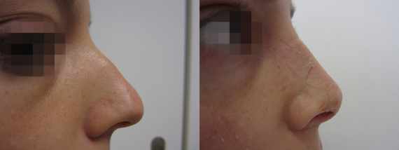 Operace nosu před a po
