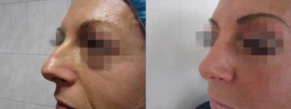 Operace nosu před a po