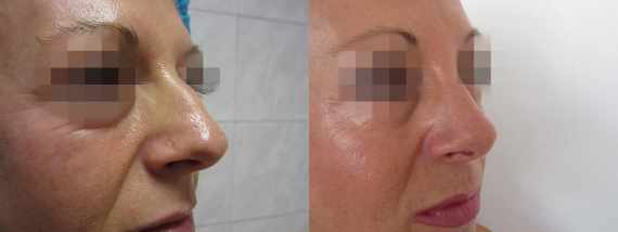 Operace nosu před a po