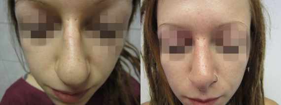 Operace nosu před a po