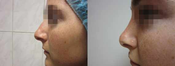 Operace nosu před a po