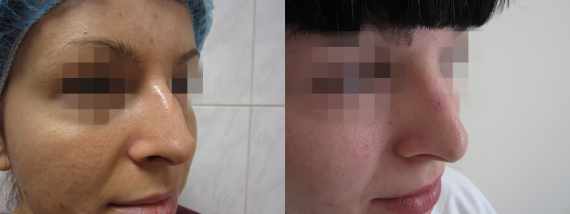 Operace nosu před a po