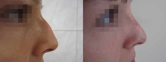 Operace nosu před a po