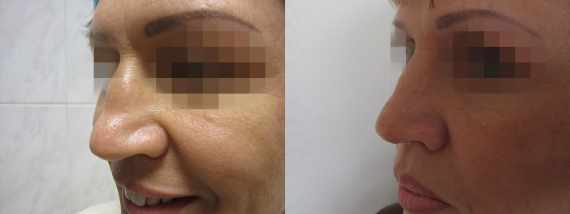 Operace nosu před a po