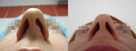 Operace nosu před a po