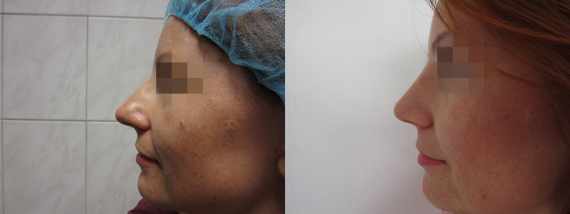 Operace nosu před a po