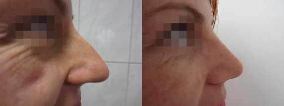 Operace nosu před a po