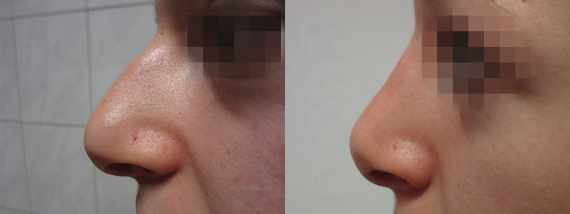 Operace nosu před a po