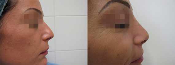 Operace nosu před a po