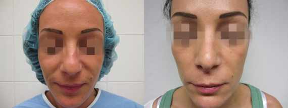 Operace nosu před a po