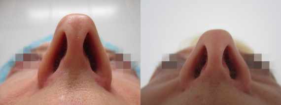 Operace nosu před a po