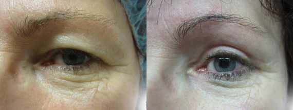 Operace očních víček před a po