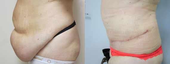 Fotografie Plastika břicha před a po