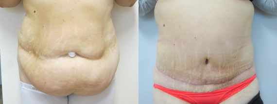 Fotografie Plastika břicha před a po