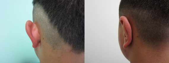 Plastika uší fotografie před a po