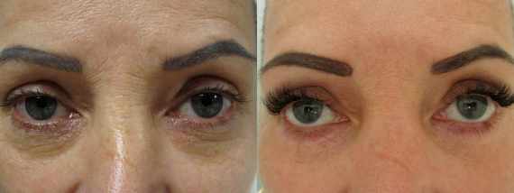 Plastická operace dolních víček před a po fotografie