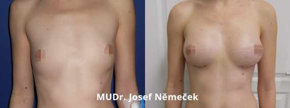 Foto před a po zvětšení prsou