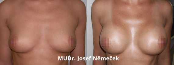Foto před a po zvětšení prsou