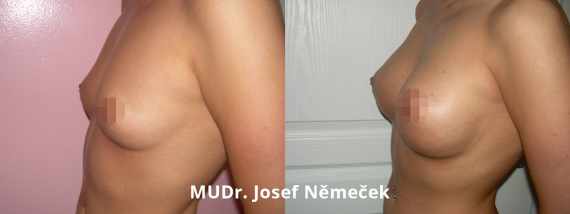 Foto před a po zvětšení prsou