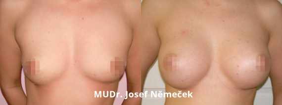 Foto před a po zvětšení prsou