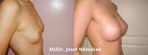zvětšení prsou