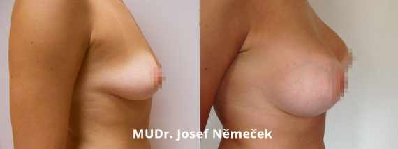 Foto před a po zvětšení prsou