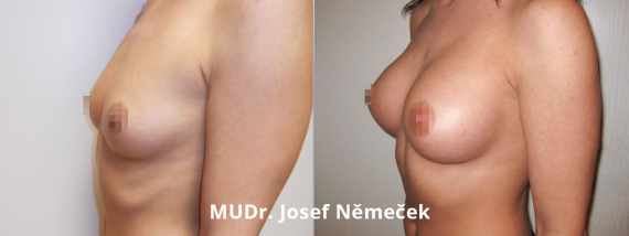 Foto před a po zvětšení prsou