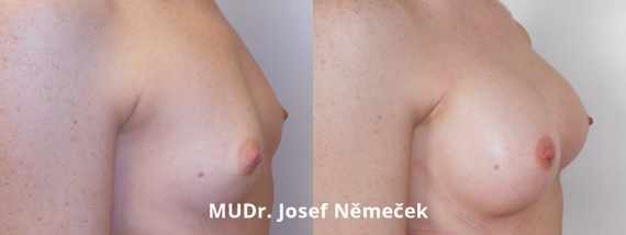Foto před a po zvětšení prsou