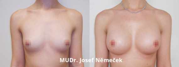Foto před a po zvětšení prsou