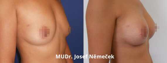 zvětšení prsou