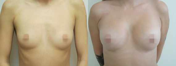 Foto před a po zvětšení prsou