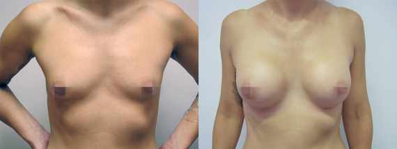 Foto před a po zvětšení prsou