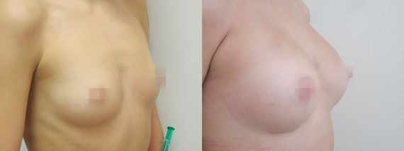 Foto před a po zvětšení prsou