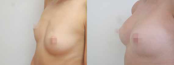 Foto před a po zvětšení prsou