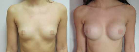Foto před a po zvětšení prsou