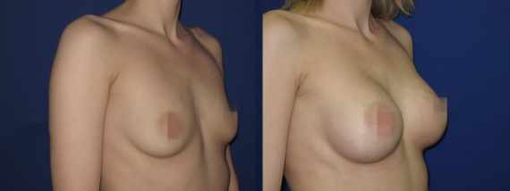 Foto před a po zvětšení prsou